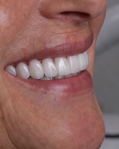 Full Arch Transformation - After