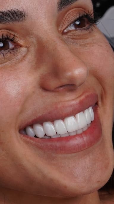 Veneer Enhancement - After