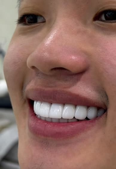 Full Smile Makeover - After