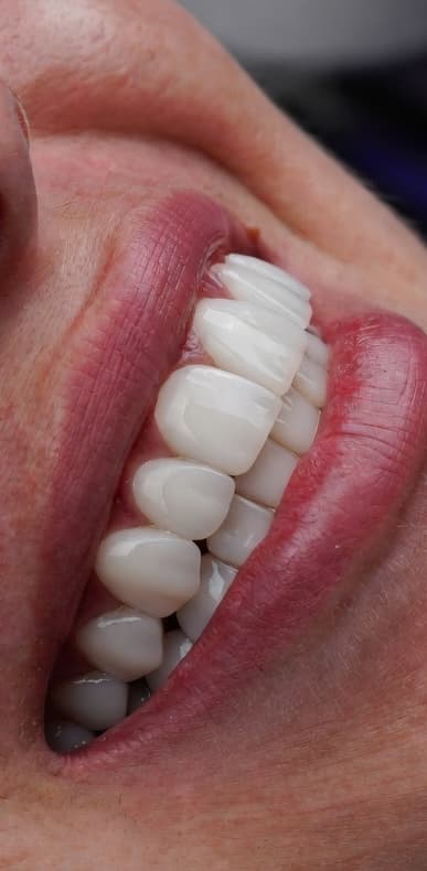 Natural Smile Design - After