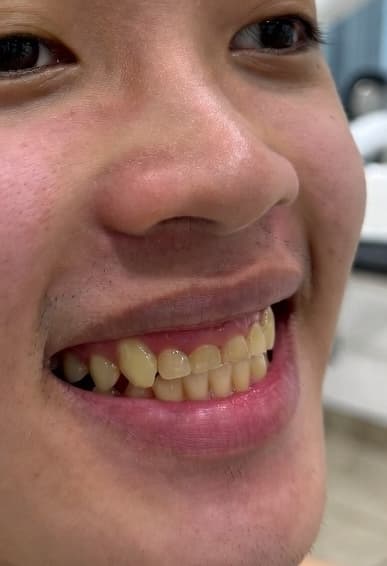 Full Smile Makeover - Before
