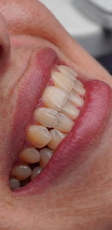 Natural Smile Design - Before